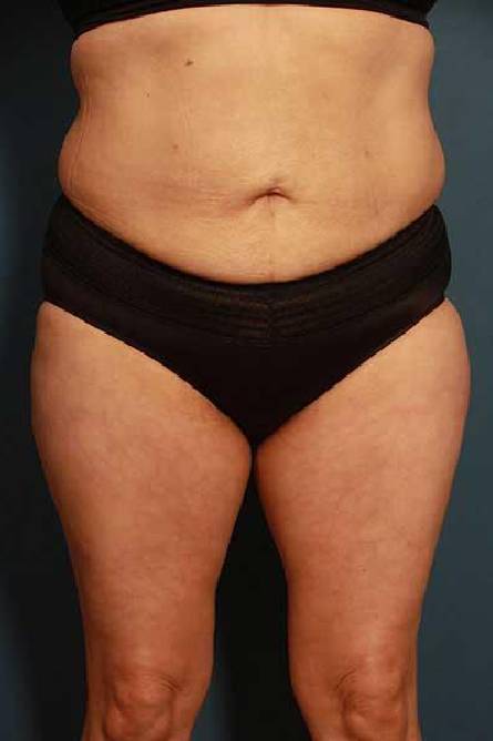 after liposuction female patient front view case 689