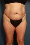 before liposuction female patient front view case 689