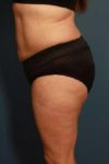 after liposuction female patient left side view case 689