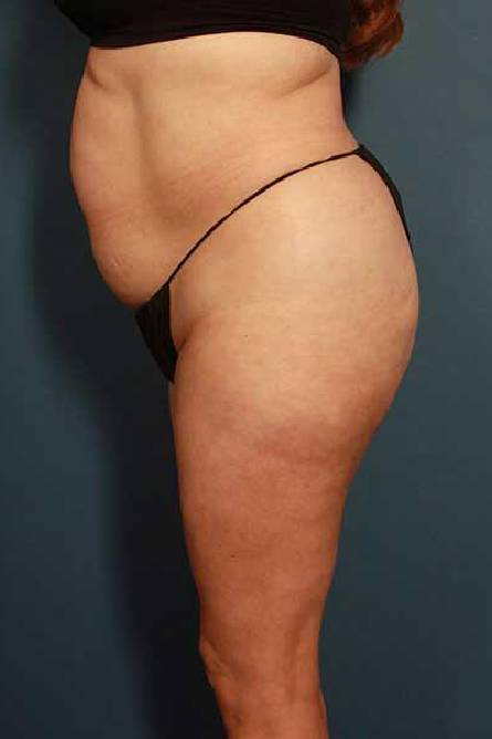 before liposuction female patient left side view case 689