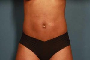 before liposuction female patient front view case 692