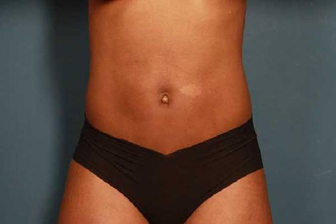 before liposuction female patient front view case 692