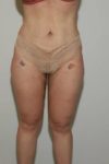 after liposuction female patient front view case 694