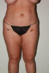 before liposuction female patient front view case 694