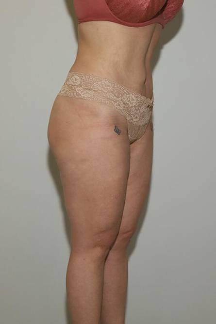 after liposuction female patient right angled view case 694