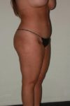 before liposuction female patient right angled view case 694