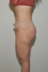 after liposuction female patient left side view case 694