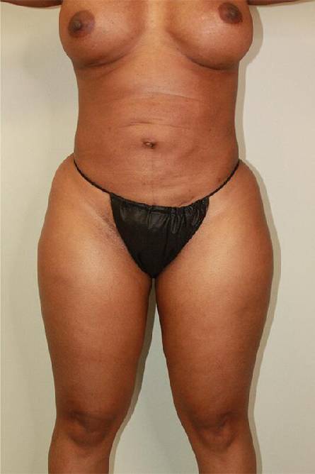 after liposuction female patient front view case 697