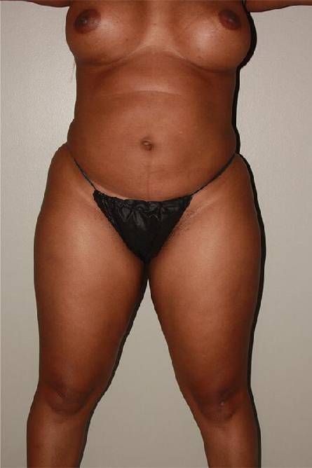 before liposuction female patient front view case 697