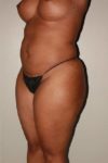 before liposuction female patient left angled view case 697