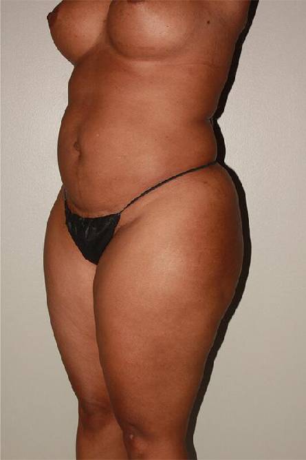 before liposuction female patient left angled view case 697