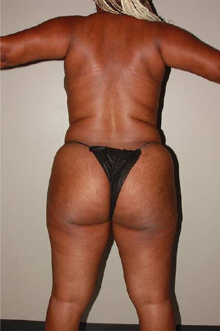 before liposuction female patient back view case 697