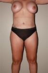 after liposuction female patient front view case 700