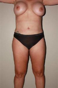 after liposuction female patient front view case 700