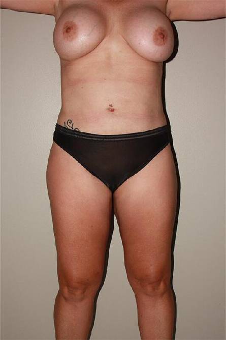 after liposuction female patient front view case 700
