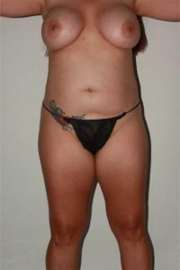 before liposuction female patient front view case 700