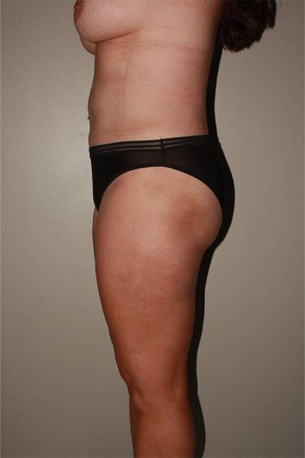 after liposuction female patient left side view case 700