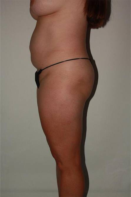 before liposuction female patient left side view case 700