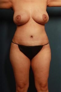 after mommy makeover female patient front view case 715