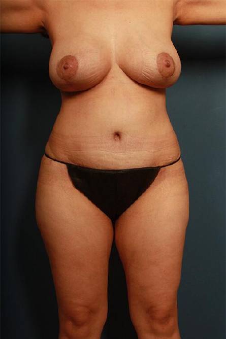 after mommy makeover female patient front view case 715