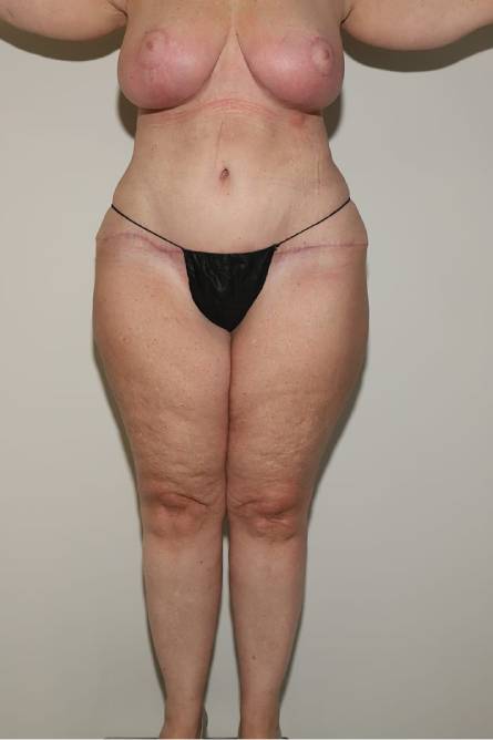after mommy makeover female patient front view case 720