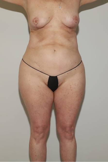 before mommy makeover female patient front view case 728