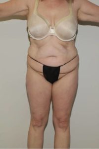before mommy makeover female patient front view case 731