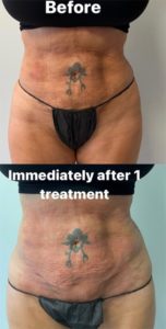 before and after opus laser front view female patient case 687