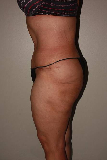 after panniculectomy female patient left side view case 682