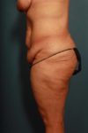 before panniculectomy female patient left side view case 682