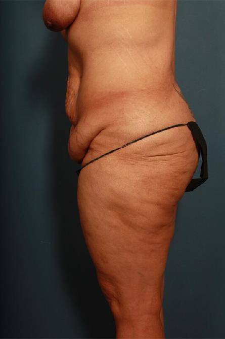 before panniculectomy female patient left side view case 682