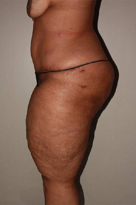 after panniculectomy female patient left side view case 685