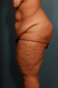 before panniculectomy female patient left side view case 685