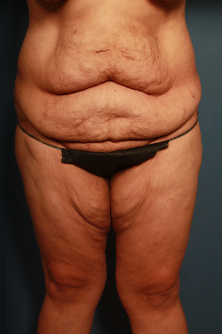 before panniculectomy female patient front view case 682