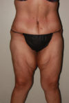 after panniculectomy female patient front view case 682