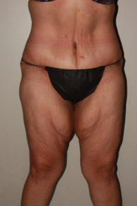 after panniculectomy female patient front view case 682