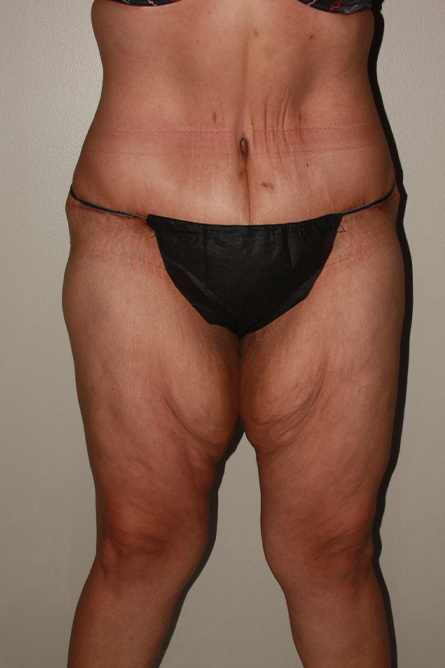 after panniculectomy female patient front view case 682