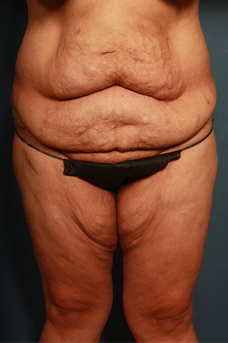 before body lift female patient front view | Houston