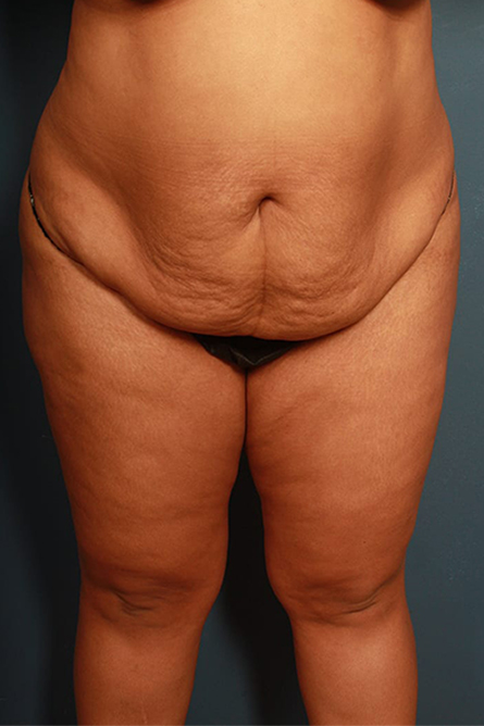 before body lift female patient front view | Houston