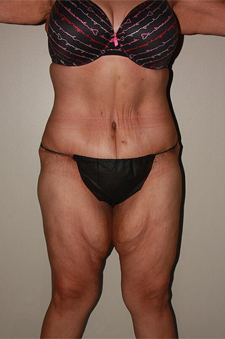 after body lift female patient front view | Houston