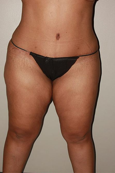 after body lift female patient front view | Houston