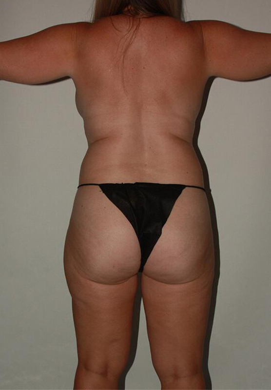 before liposuction back view female patient