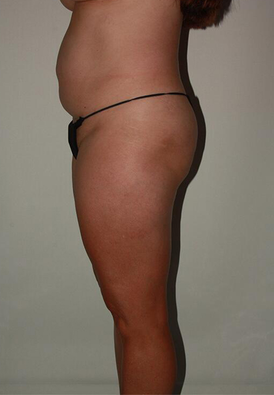 before liposuction left side view female patient