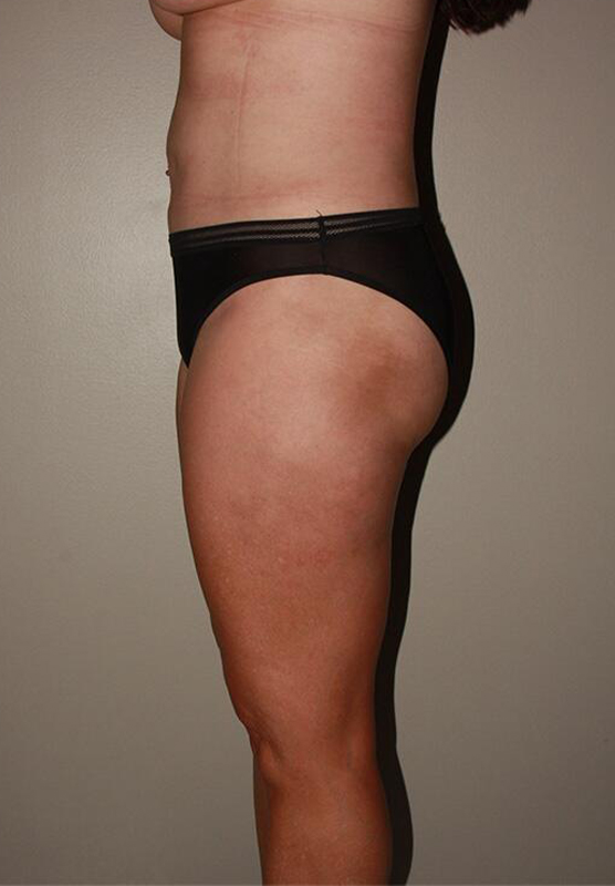 after liposuction left side view female patient