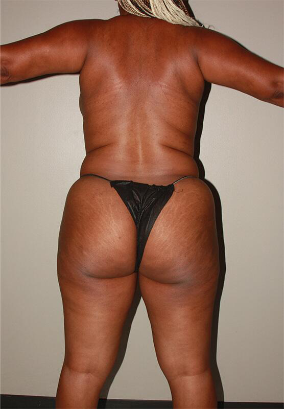 before liposuction back view female patient