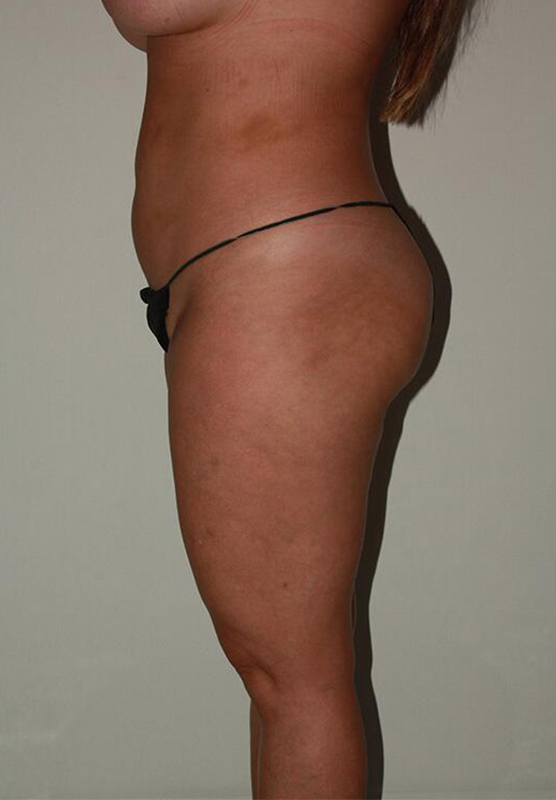 before liposuction left side view female patient