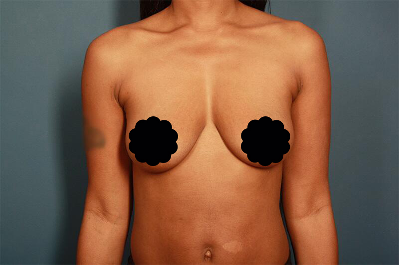 before breast augmentation front view