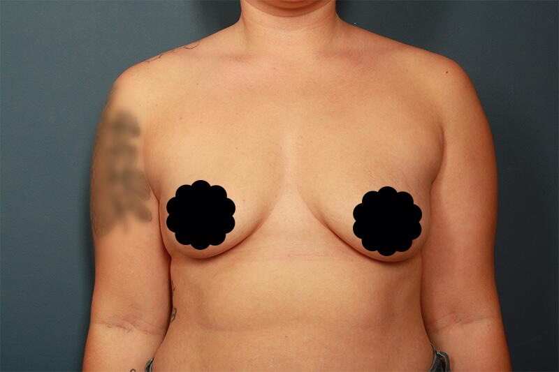 before breast augmentation front view