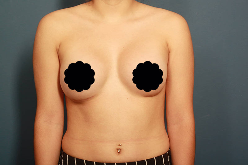after breast augmentation front view