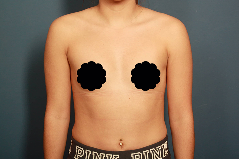 before breast augmentation front view